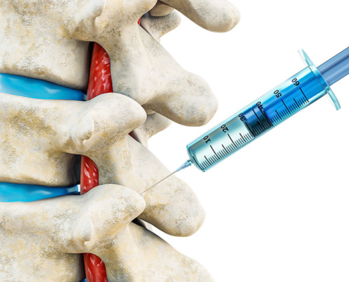 3D illustration of spine with syringe facet joint injection